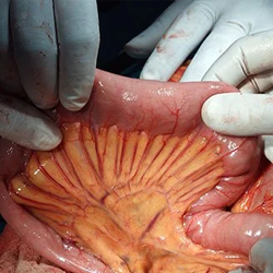 Intestine Surgery